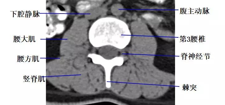 颈椎腰椎疾病ct及mri诊断,腰椎ct可以发现肠部病变吗
