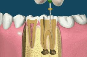 根管治疗做冠的牙齿会裂开吗,根管治疗后牙齿裂了还能做外冠吗