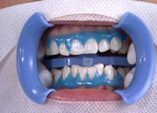 牙齿变白的美牙神器,牙齿黄如何美牙