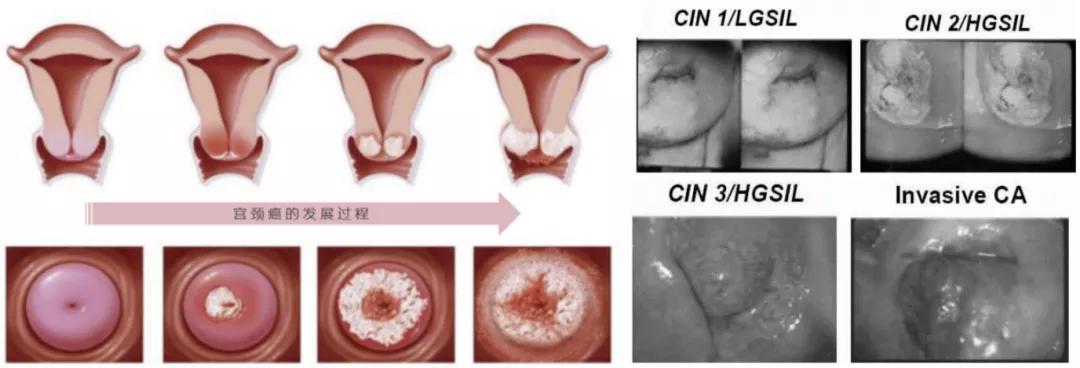 2价hpv疫苗和2价hpv吸附疫苗区别,hpv疫苗深度解析