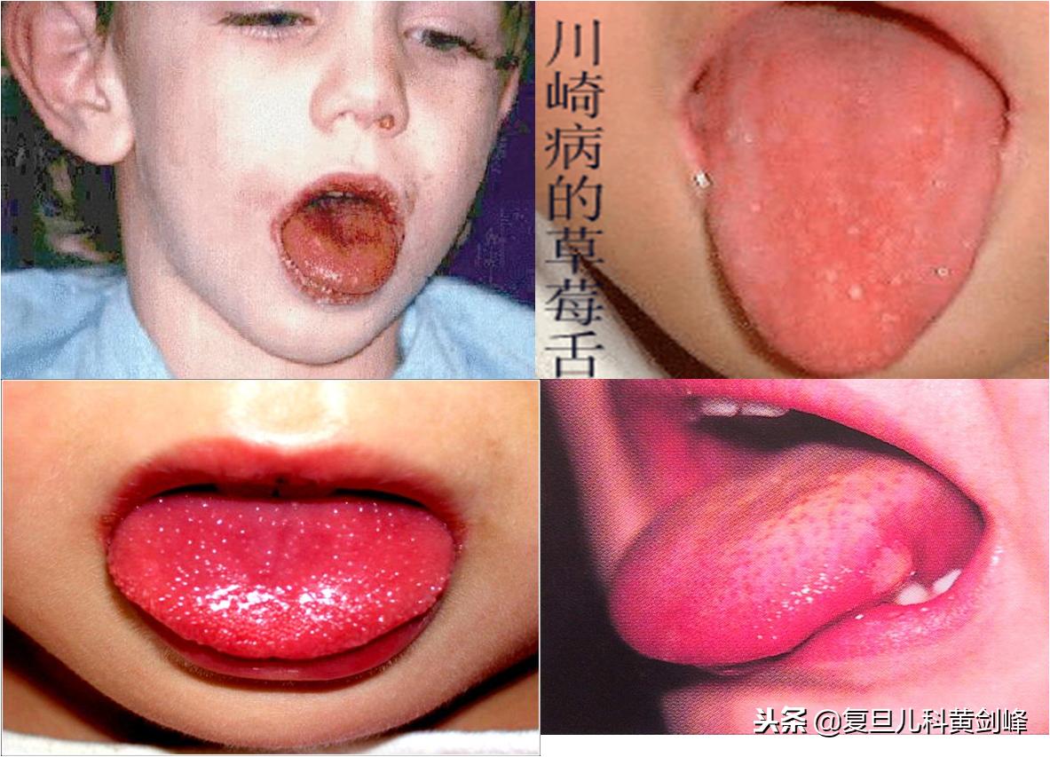 发热白细胞高达25什么原因,发热白细胞高c反应蛋白高