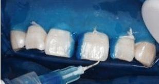 门牙缝可以补吗,门牙有缝怎么办如何补救