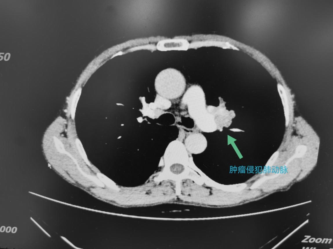 肺癌综合诊疗,肺癌诊疗一体化模式