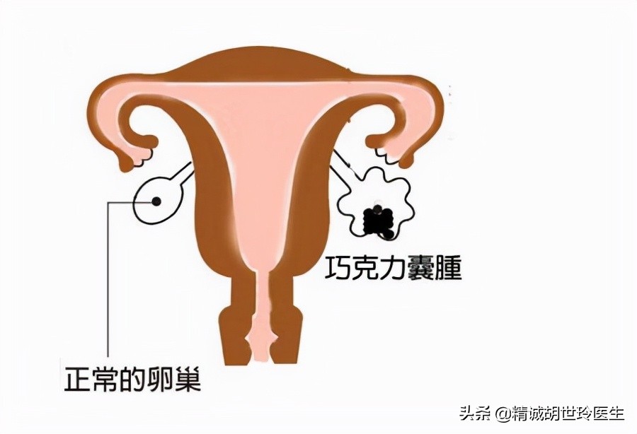 炎性卵巢囊肿和巧克力囊肿的区别,巧克力囊肿是做手术还是试管