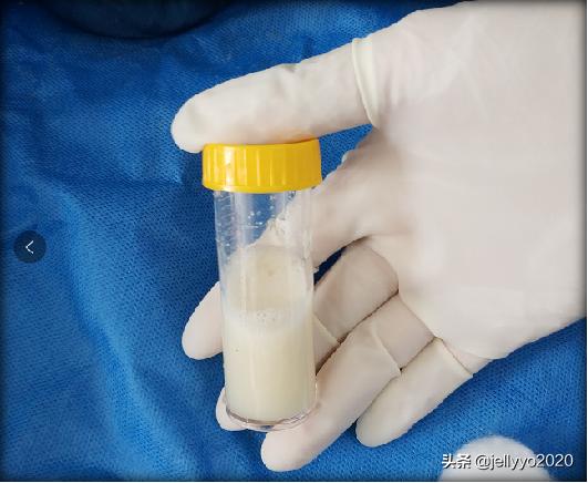 支气管镜第二次消毒多久,支气管镜肺泡灌洗怎么做的