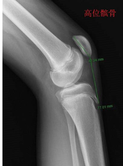 膝关节去神经化治疗,膝关节退化保守治疗可以吗