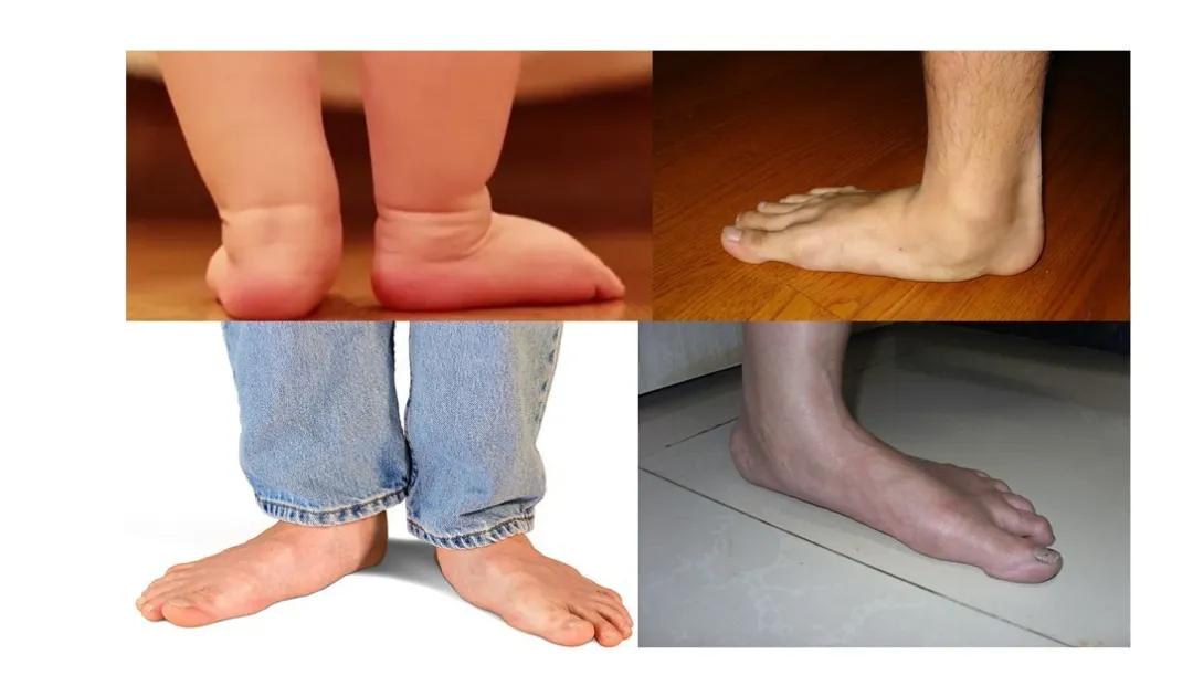 儿童扁平足的矫正训练,儿童矫正扁平足的最佳锻炼方法