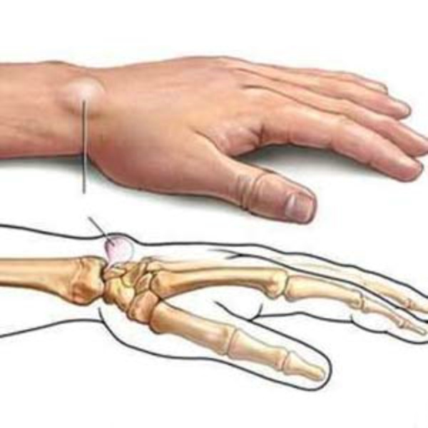 手腕疼并冒出一个包,一干活手腕就疼