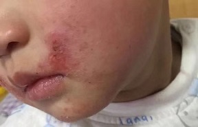 说说湿疹那些事儿,谈湿疹的治疗