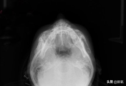 18岁土肥圆豪掷800万全身整形，鼻子6次大整假体穿出，效果却超美