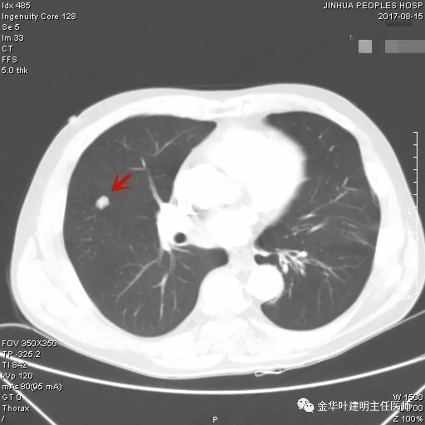 叶建明谈胸膜下的实性结节,叶建明肺实性良性结节会变癌症吗