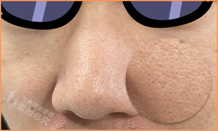 毛孔粗大怎么办教你一招收缩毛孔,毛孔粗大怎么办教你拯救方法