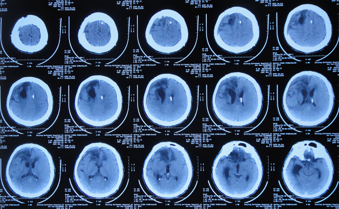 开颅手术后颅内细菌感染图片,外伤开颅手术后脑积液能恢复吗