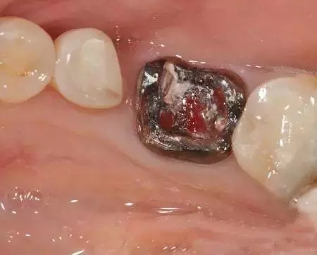 宝宝牙齿摔断了什么时候长,孩子摔断门牙妈妈伤心自责