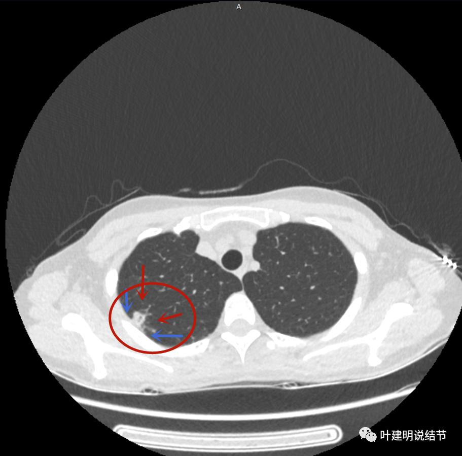 临床诊断孤立性肺结节,空洞型结节一般是什么性质