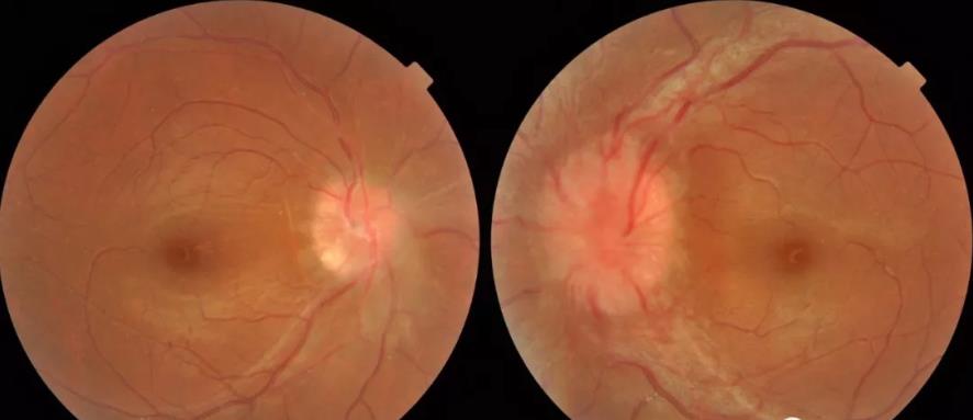 颅高压第一篇：视乳头水肿