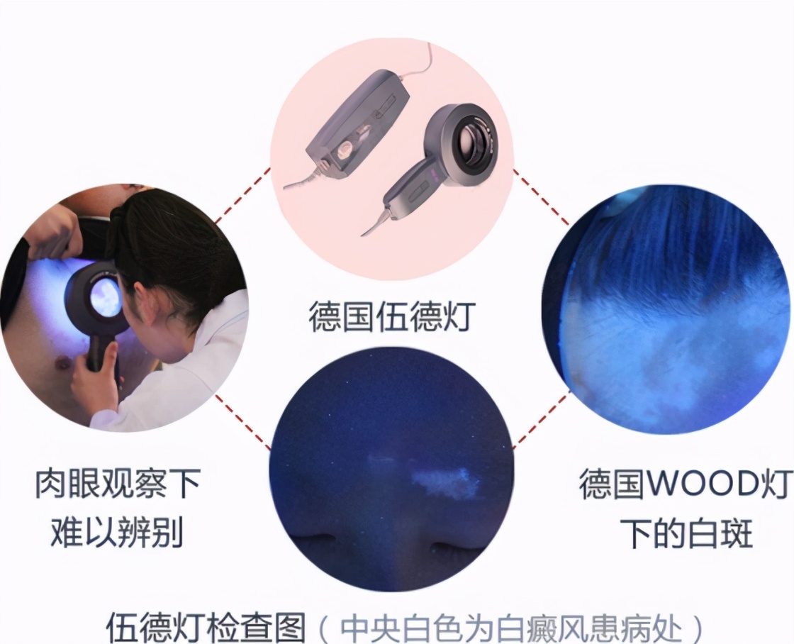 白癜风皮肤问题,皮肤白斑和白癜风能治好吗