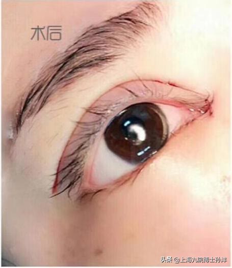 整形美容孙沣博士,上海九院孙沣博士眼角修复
