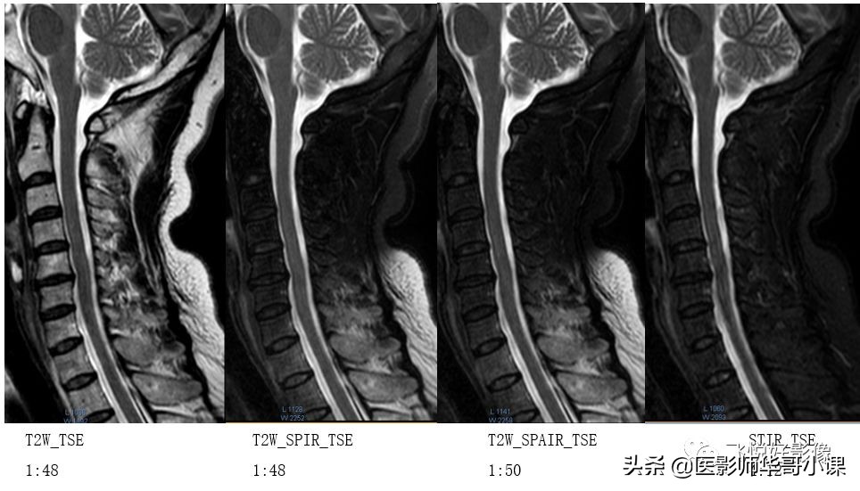 飞利浦磁共振独有技术,飞利浦磁共振减影技术
