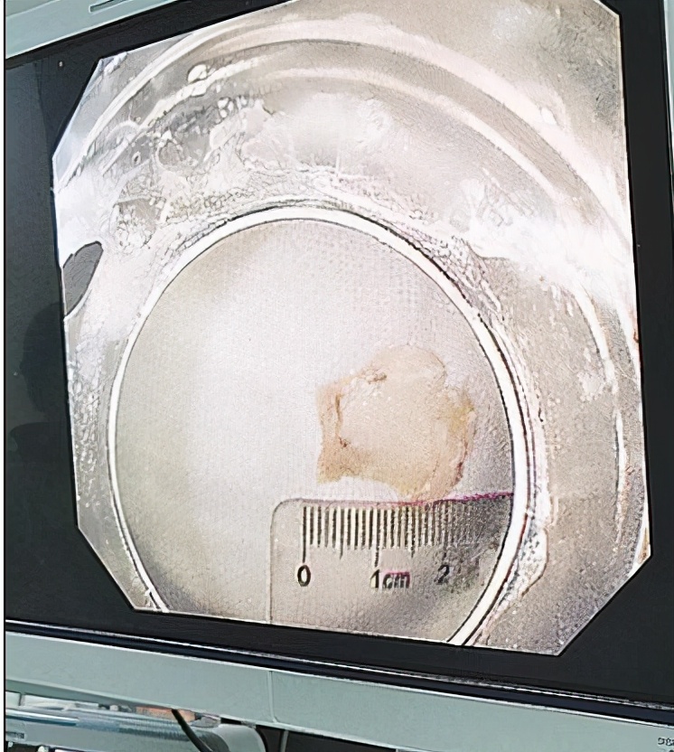 鱼刺卡喉咙女子后续,喉咙内窥镜检查取鱼刺