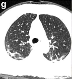 新型冠状病毒感染的肺炎患者肺部影像学改变