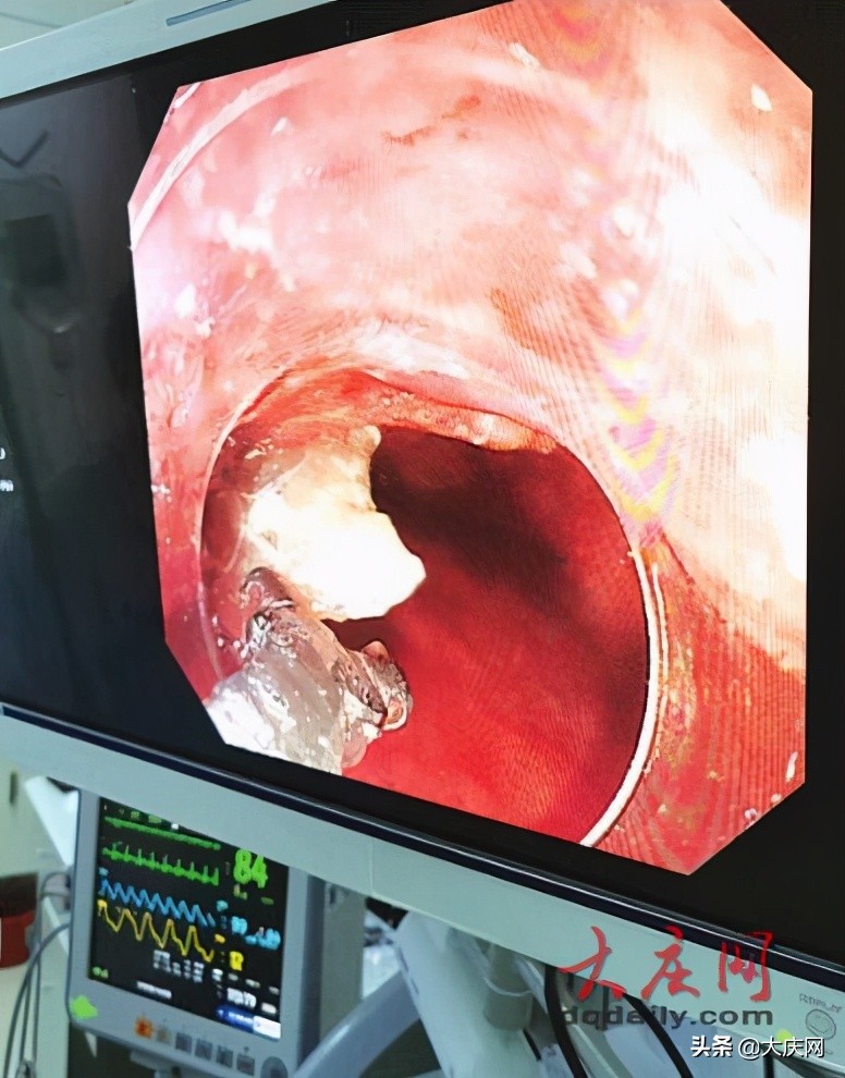 女子鱼骨卡喉,鱼刺卡住做喉镜取出全过程