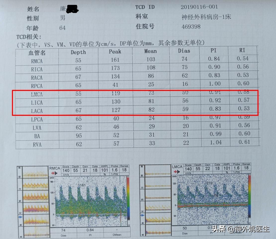 颈内动脉狭窄内膜剥脱术风险大吗,颈动脉内膜摘除手术