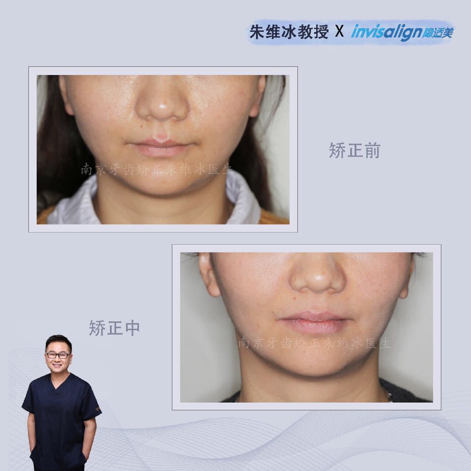 隐适美牙齿拥挤矫正真实案例,南京朱维冰