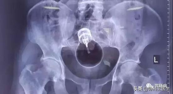 为什么会把异物塞进尿道,为什么会有人往尿道里塞异物