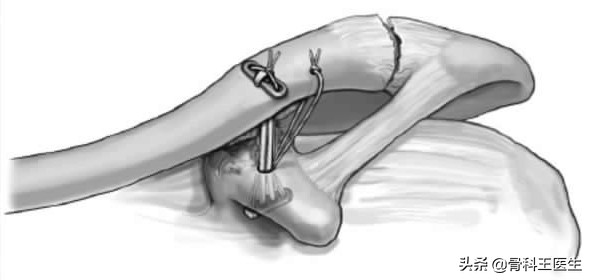 武磊肩锁关节脱位怎么治疗,武磊肩部受伤