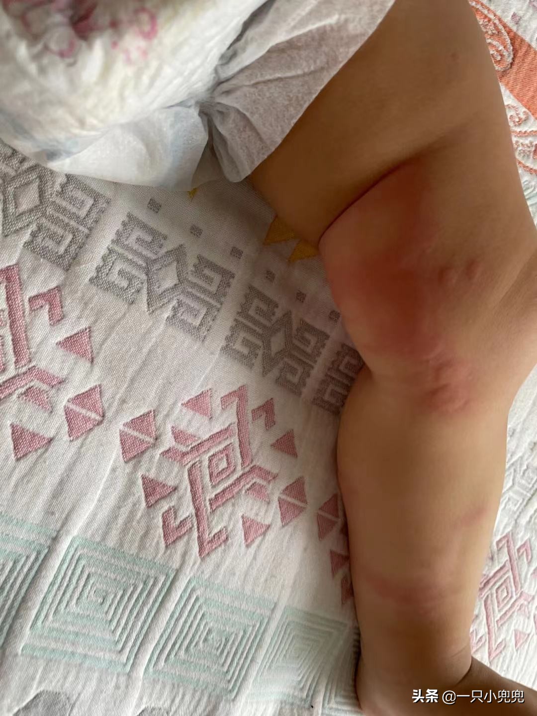 宝宝过敏怎么办六个妙招帮助你,宝宝过敏怎么办看完这篇轻松应对