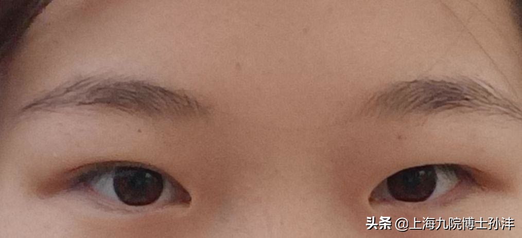 上海九院孙沣博士眼角修复,上海九院美容科孙沣