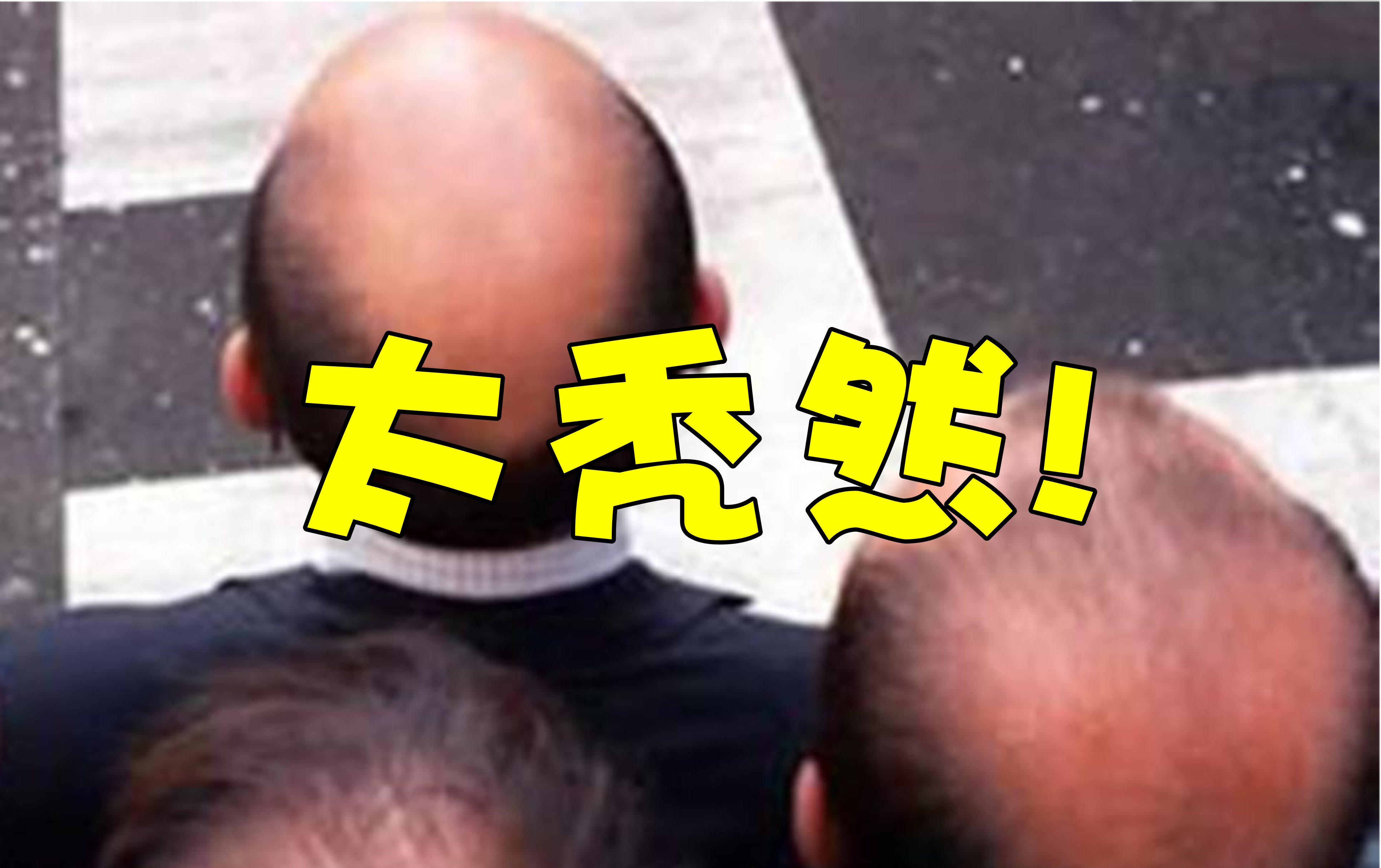 m型脱发也帅的男明星,帅气也挡不住脱发的10位男明星