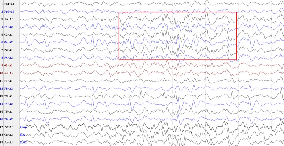 临床常见脑电图,教您三分钟读懂脑电图