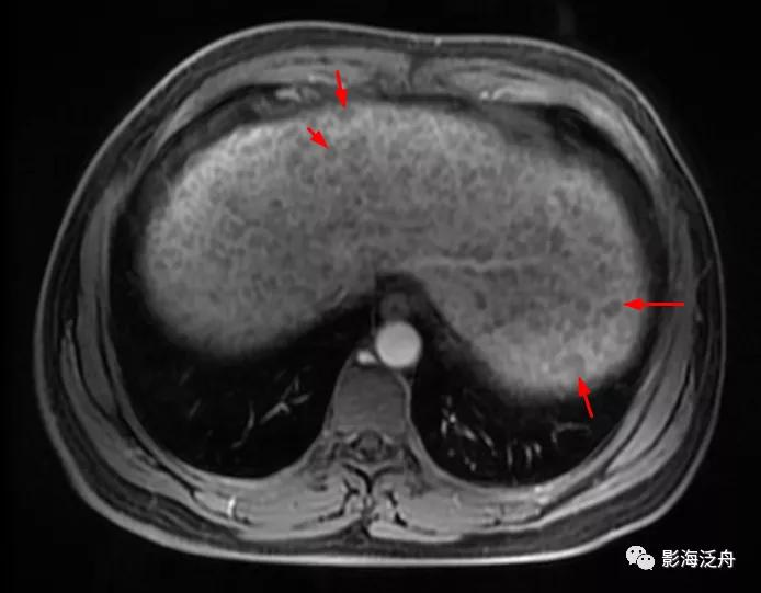 肝脏弥漫性病变严重吗,肝脏弥漫性的病变的症状