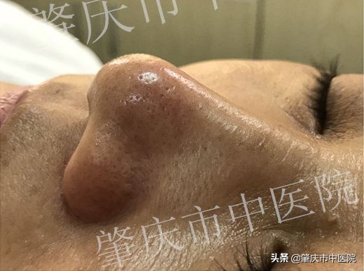 春夏之交,黑头来袭?这才是正确祛除黑头的打开方式!