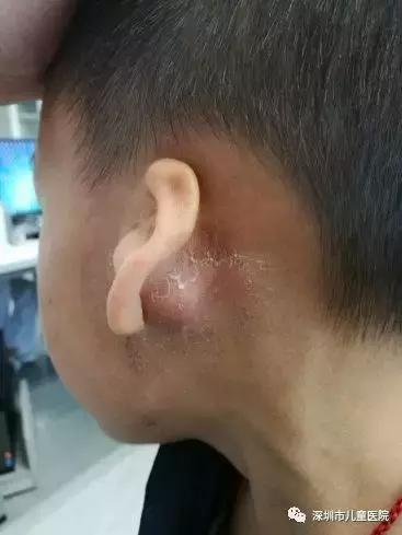 小孩子发烧后耳朵后面长大包,五岁男孩发烧后身上出现红疹子