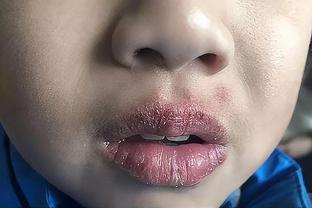 冬季孩子嘴唇起皮、干裂还出血?三招教你正确护理,光喝水没用
