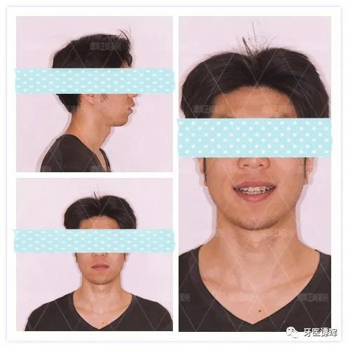 牙齿不齐牙列拥挤怎么矫正,牙列不齐拥挤矫正大约要多少钱