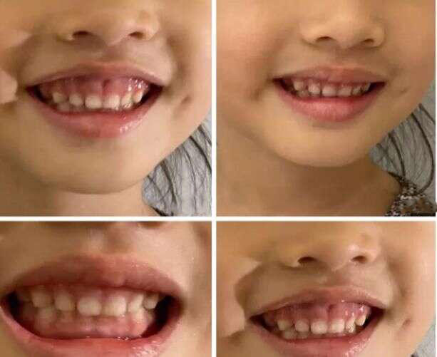 孩子笑起来牙龈露出来怎么办,孩子笑起来露牙龈需要矫正么