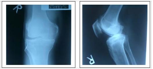 类风湿造成的关节变形可恢复吗？大多不行，有两种情况可以