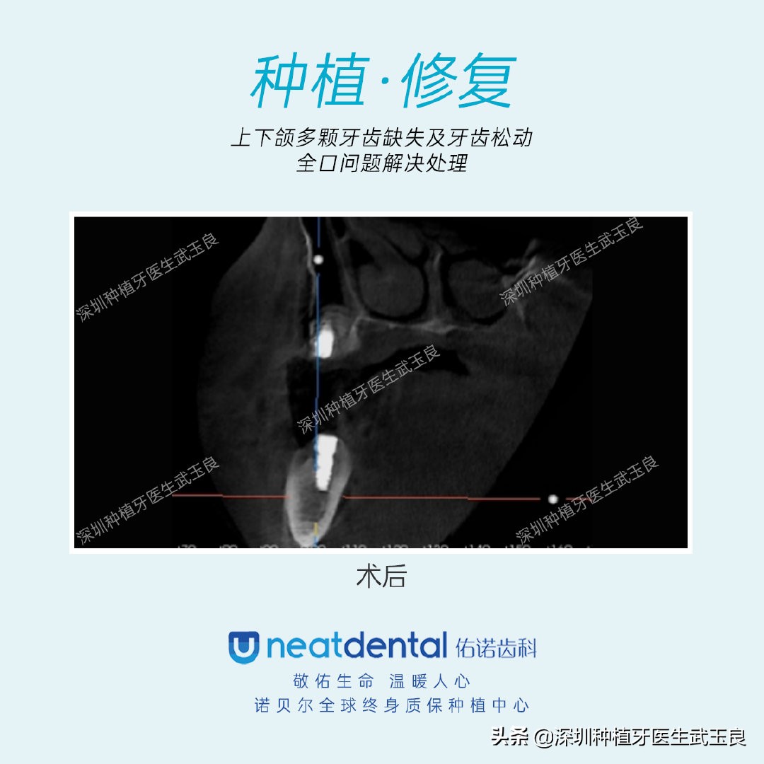 多颗牙齿缺失怎么修复全过程,多颗缺失牙修复案例