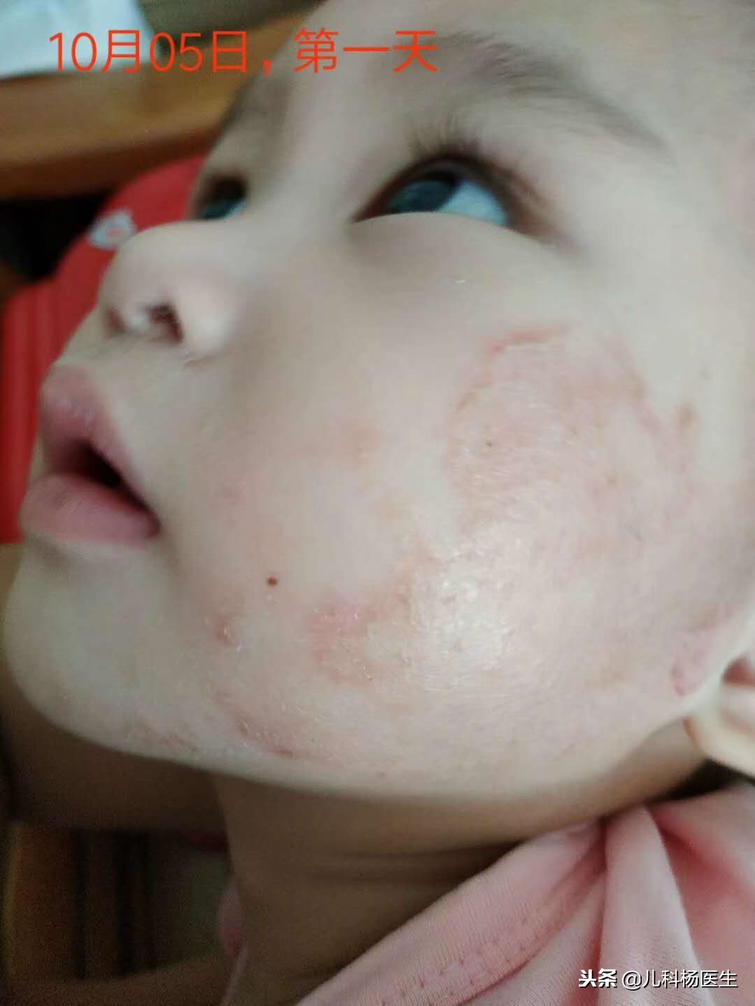 宝宝湿疹涂了炉甘石又严重了,宝宝湿疹抹了药更严重了