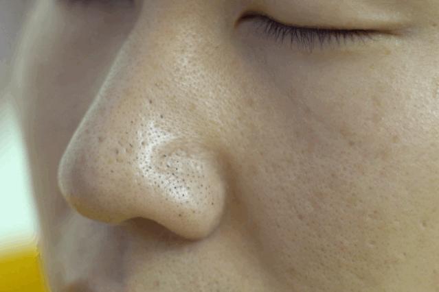 长黑头VS不长黑头差距这么大?精致女孩如何绕过黑头这道坎?