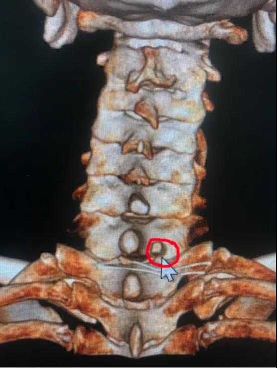 *安泰**市中心医院成功开展颈椎后路内镜“钥匙孔”技术治疗高度游离的颈椎间盘突出症