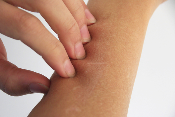 手上起的小水泡是汗疱疹还是湿疹,手上起小水泡很痒是湿疹还是过敏