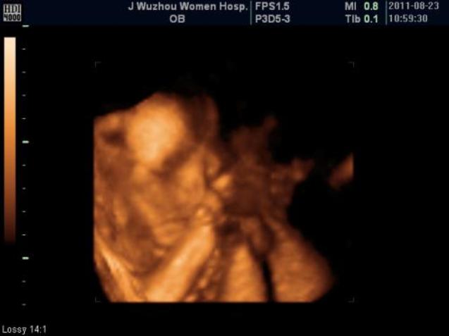 四维彩超大揭秘：怀孕了，你做四维彩超检查了吗？