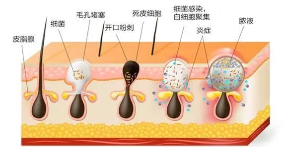 男士痘痘肌应该怎样护肤早晚,男士痘痘肌痘印护肤推荐
