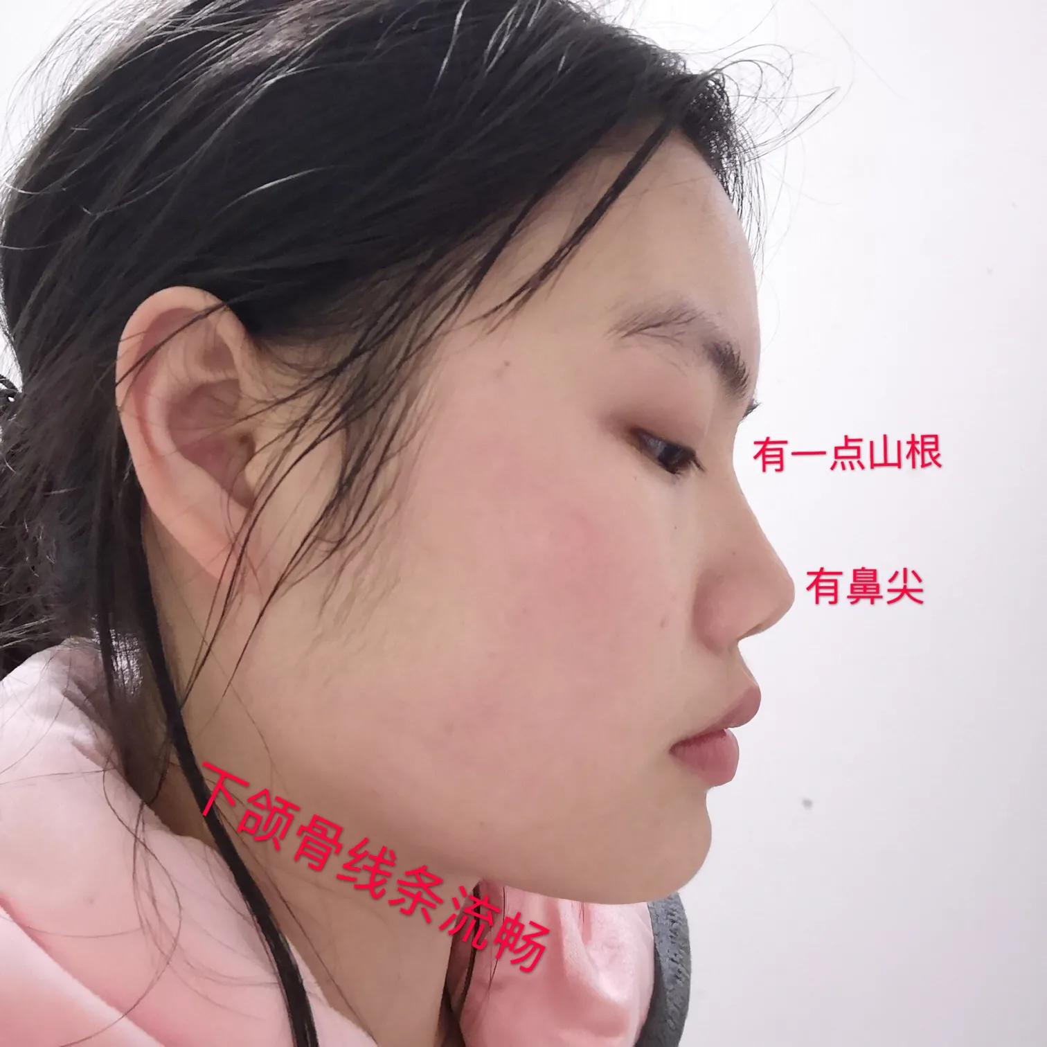 逆袭塌鼻子,逆袭鼻子