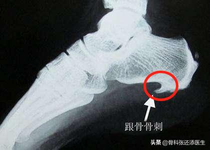 脚后跟走路疼但是没有肿起来,脚后跟走路不疼跑步疼